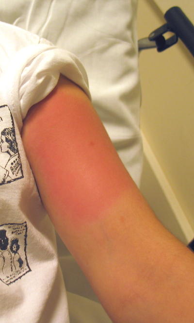 Bee Sting Symptoms Treatment Allergic Reactions Learn How A Bee Stings