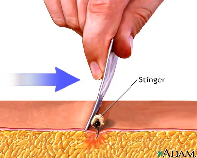 How to remove a bee stinger